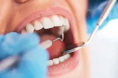 Enfermedades bucodentales: OMS advierte sobre periodontitis y  alternativas con bicarbonato de sodio